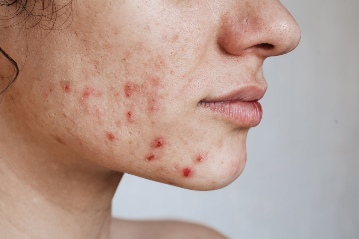 Acne Scar Treatment In Thane