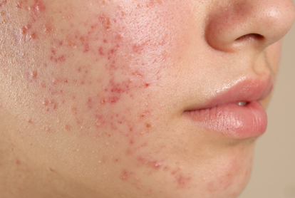 Acne Scar Treatment In Thane