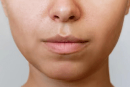 Dermal Filler Treatment In Thane