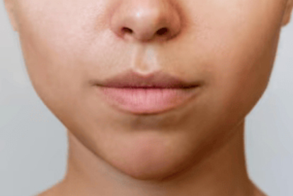 Dermal Filler Treatment In Thane