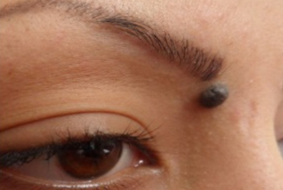 Electrosurgery Treatment In Thane
