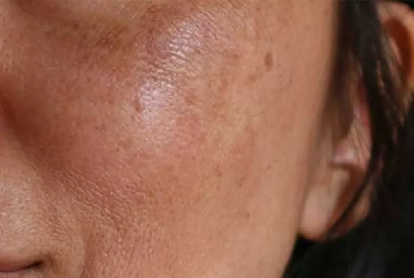 Melasma Treatment In Thane
