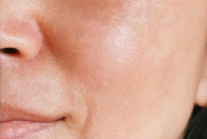 Melasma Treatment In Thane
