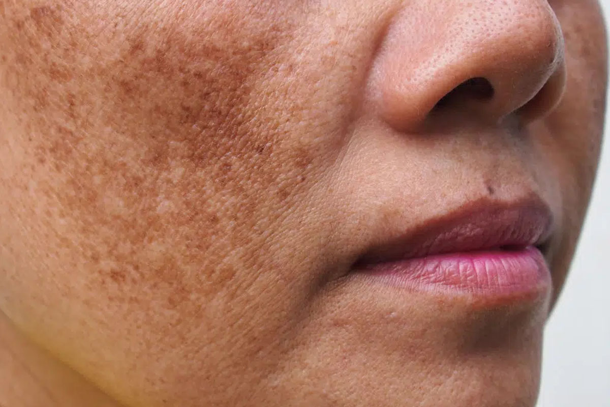 Pigmentation Treatment In Thane