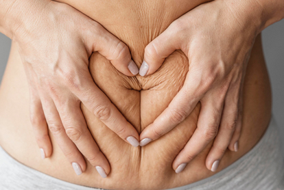 Stretch Marks Reduction Treatment In Thane
