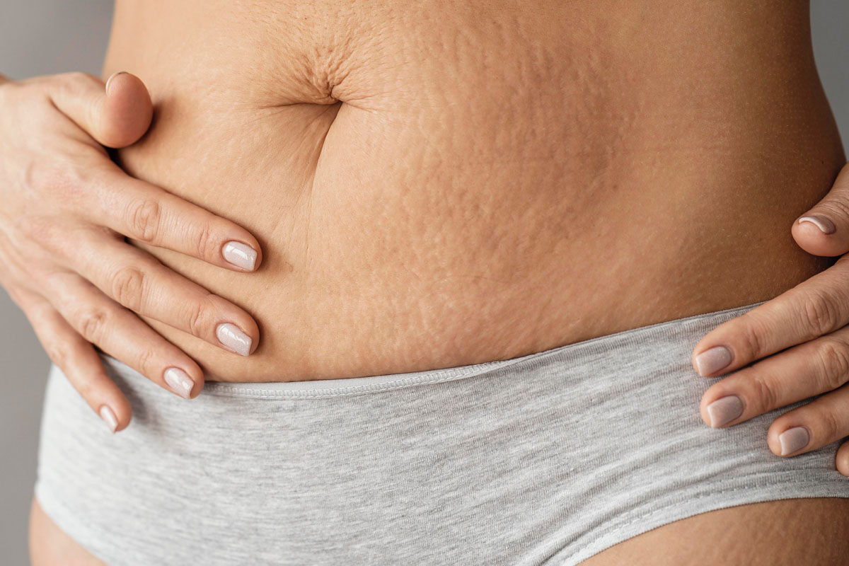 Stretch Marks Treatment In Thane