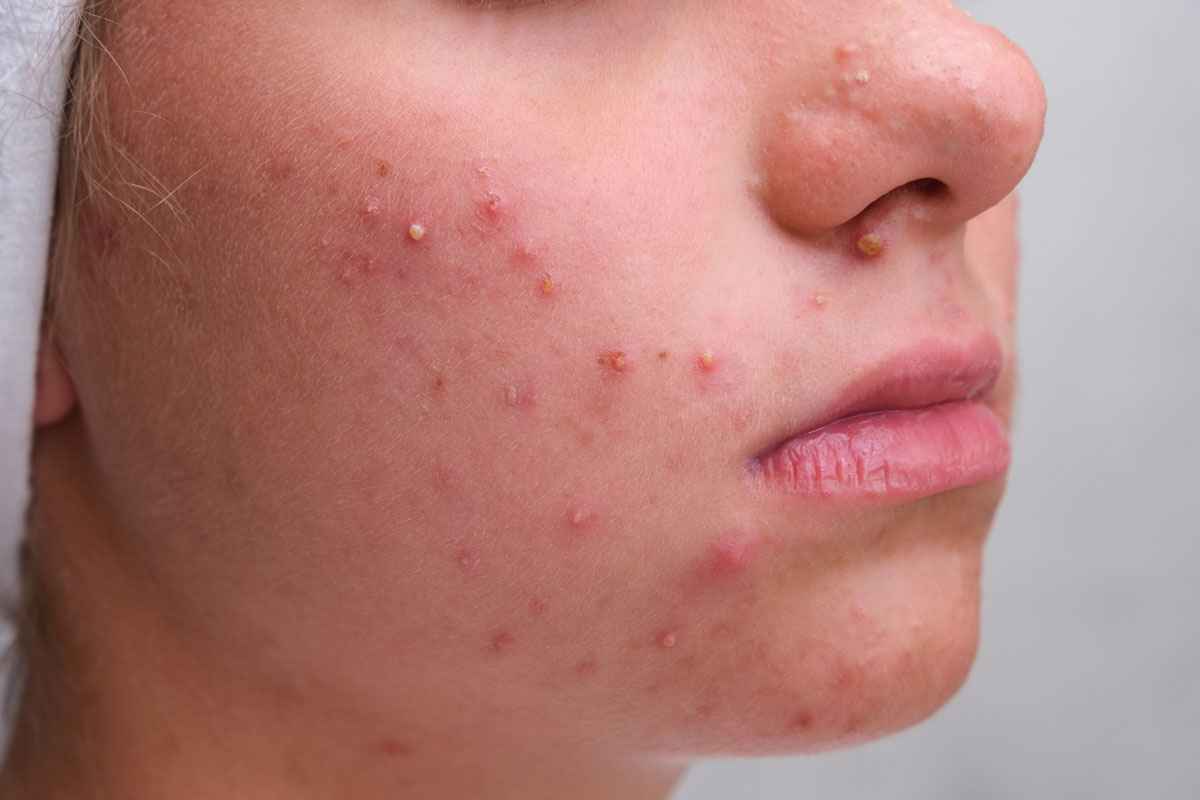 Acne Treatment In Thane