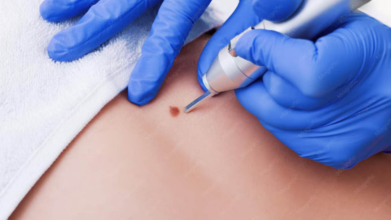 Birthmark Removal Treatment Center Hiranandani Estate Thane