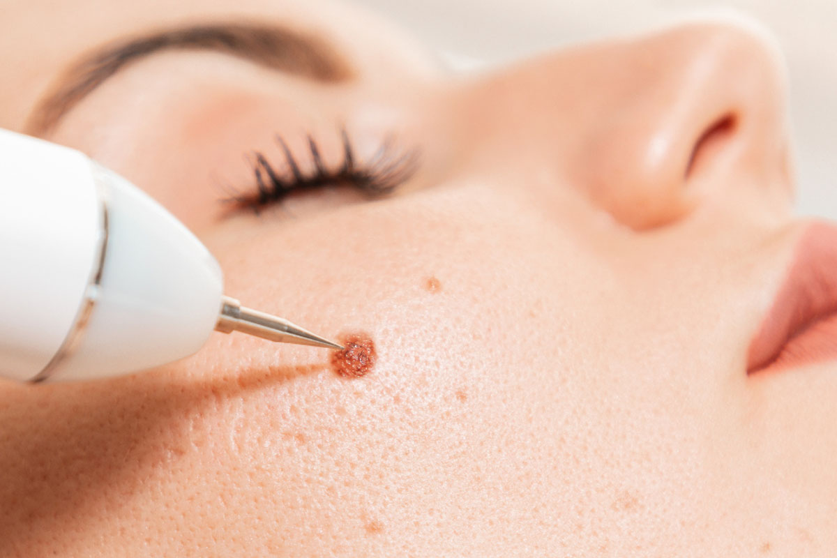 Birthmark Removal Treatment