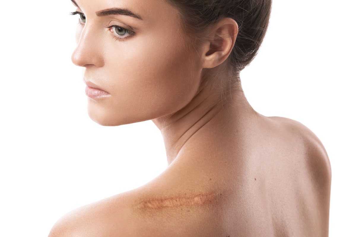 Scar Treatment In Thane